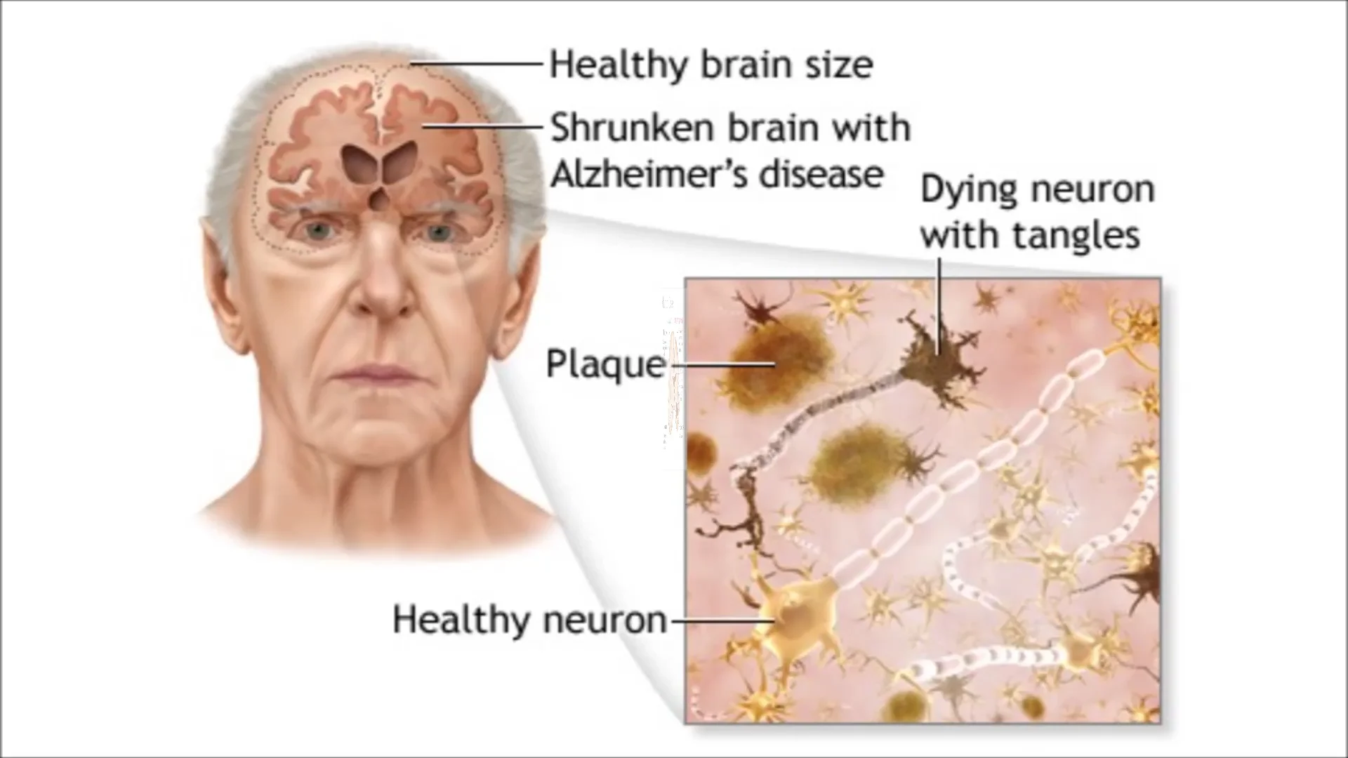 Болезнь айцгельмера это что. Болезнь Альцгеймера Нейроны. Деменция альцгеймеровского типа. Нейрофибриллярные клубки болезнь Альцгеймера.