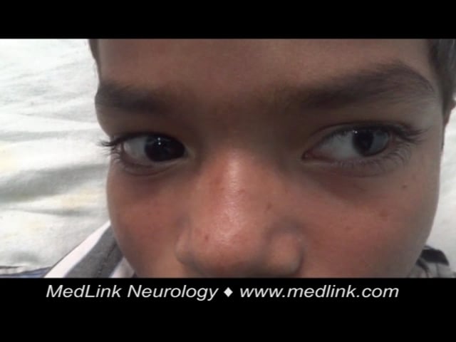 Japanese encephalitis: opsoclonus-myoclonus syndrome