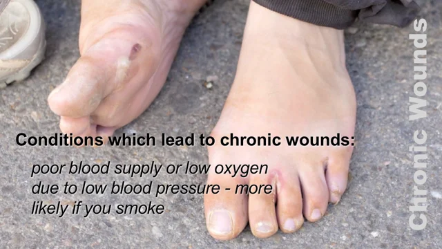 How Diabetic Socks Can Protect Your Feet  Greater Washington Advanced  Podiatry, LLC