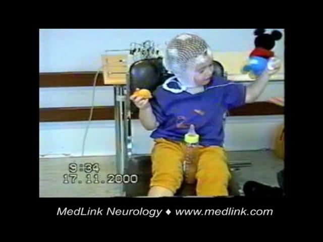 Myoclonic epilepsy in 3-year-old boy