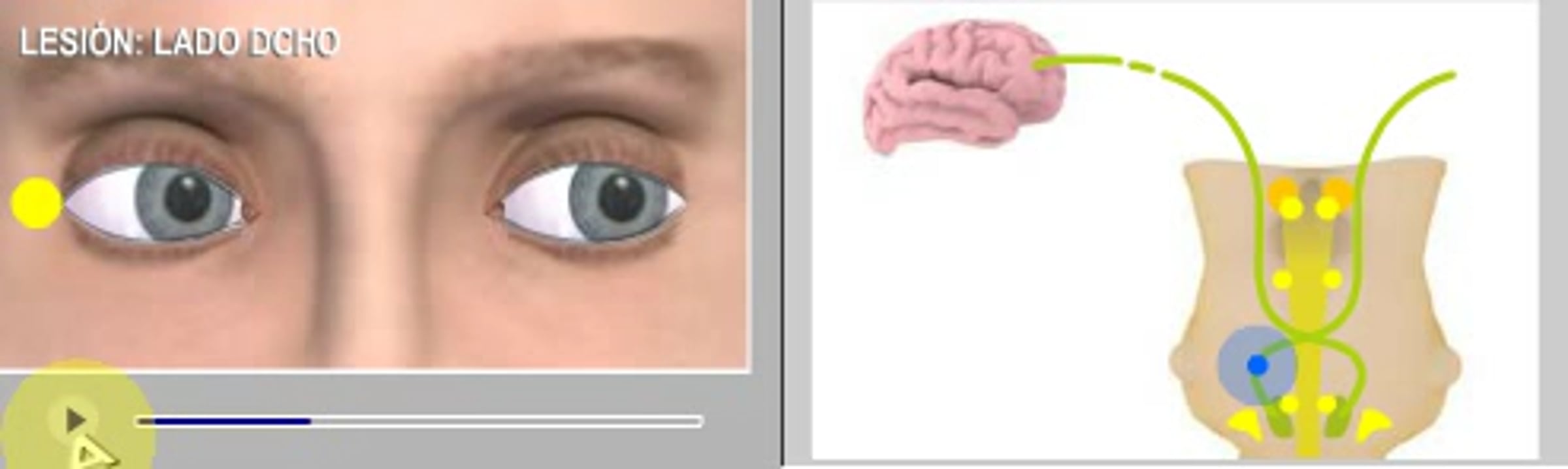 Síndrome de Foville protuberancial superior