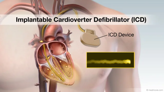 implantable cardioverter defibrillator scar