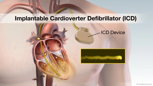 implantable cardioverter defibrillator vs pacemaker