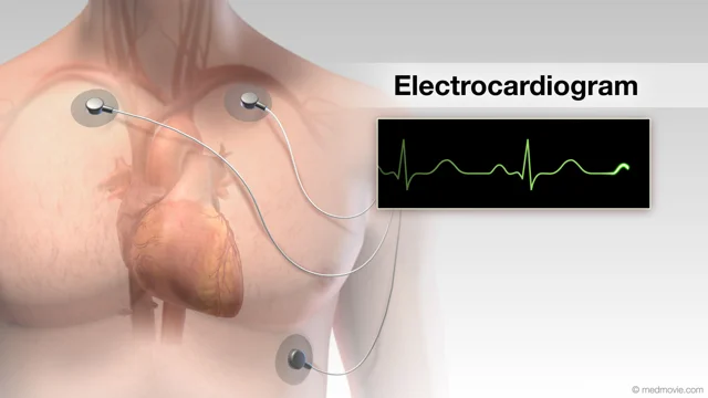 Normal heart rhythm: MedlinePlus Medical Encyclopedia Image