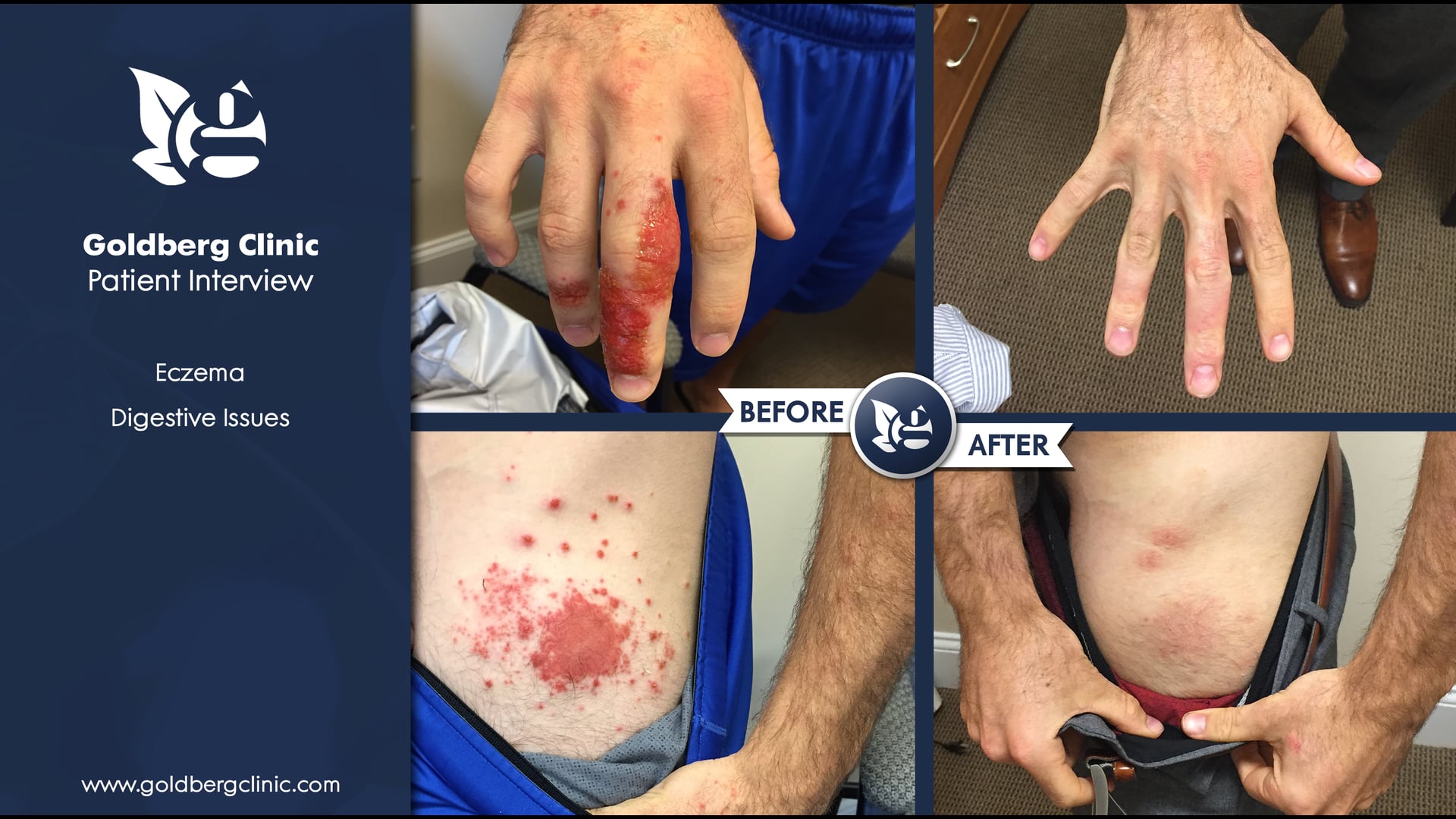 Severe Eczema and Digestive Issues