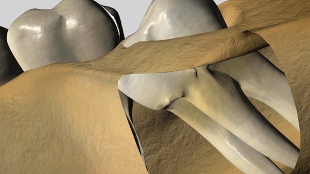 Wisdom Tooth Problems