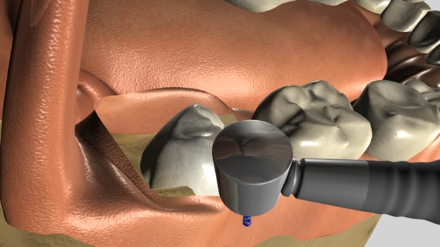 Wisdom Tooth Removal