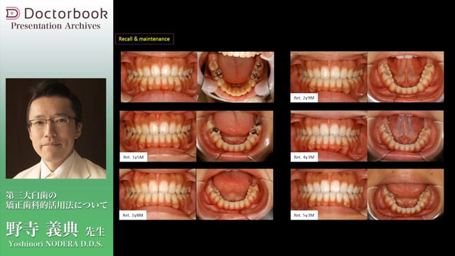 第三大臼歯の矯正歯科的活用法について