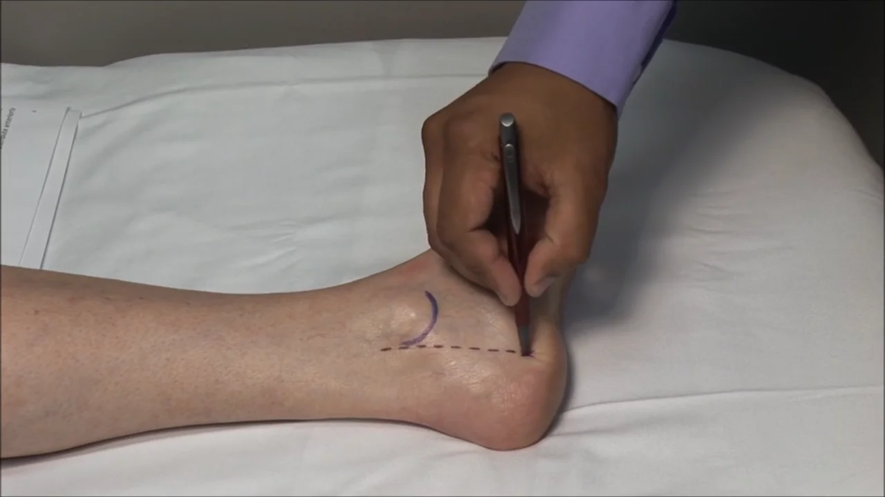 Cortisone shot in on sale heel for plantar fasciitis