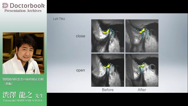 顎関節内障患者の歯科矯正治療（後編）