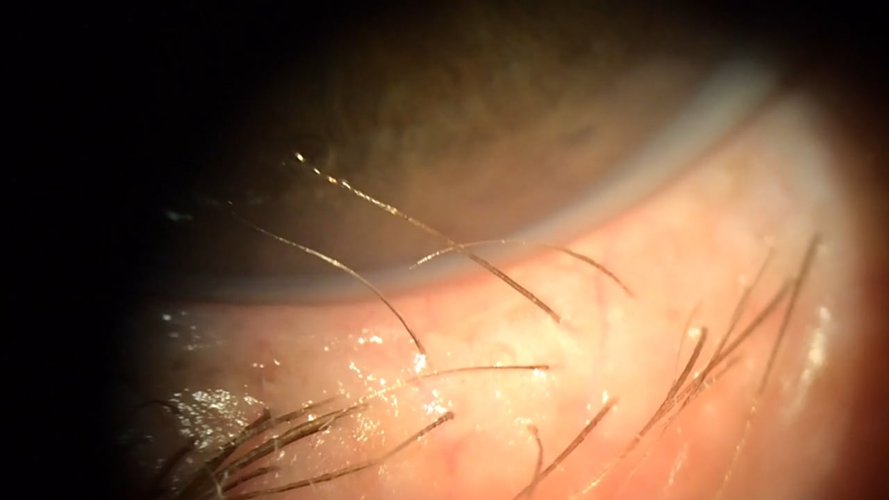 Ingrown Eyelashes Professional Removal On Vimeo   555079756 2b8b3442d995706f1bb20446fff365d1296684326b047144ca7fcde78a756bee D