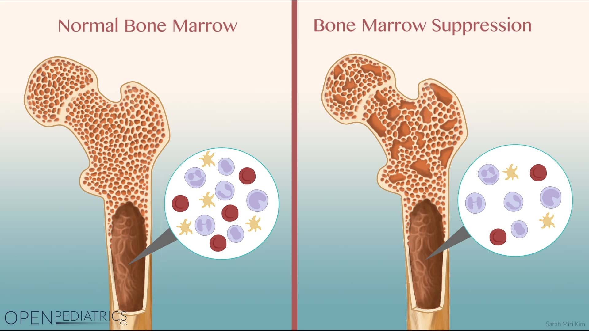 Bone marrow suppression on vimeo