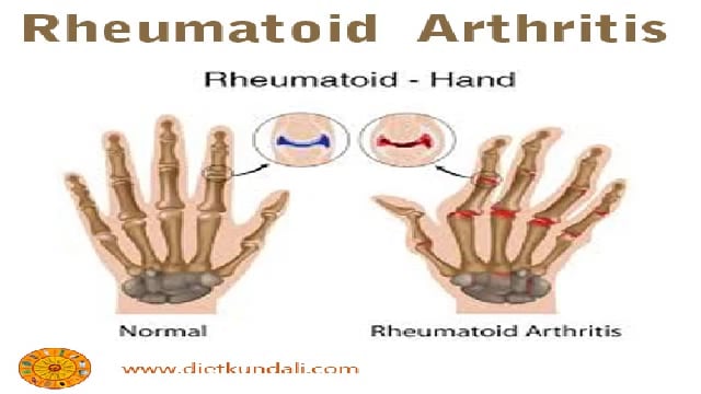 Rhematoid Arthritis Its Causes and Treatment on Vimeo