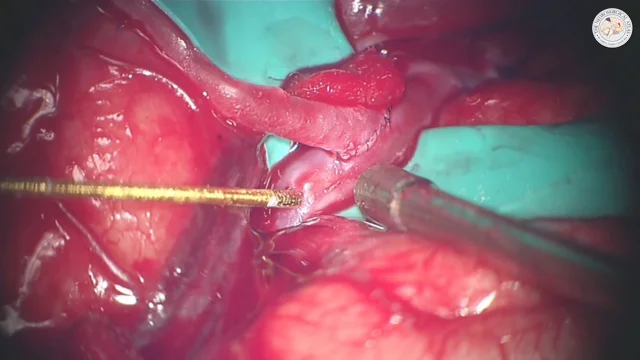 A-C. Frontal intraoperative view of a patient undergoing augmentation