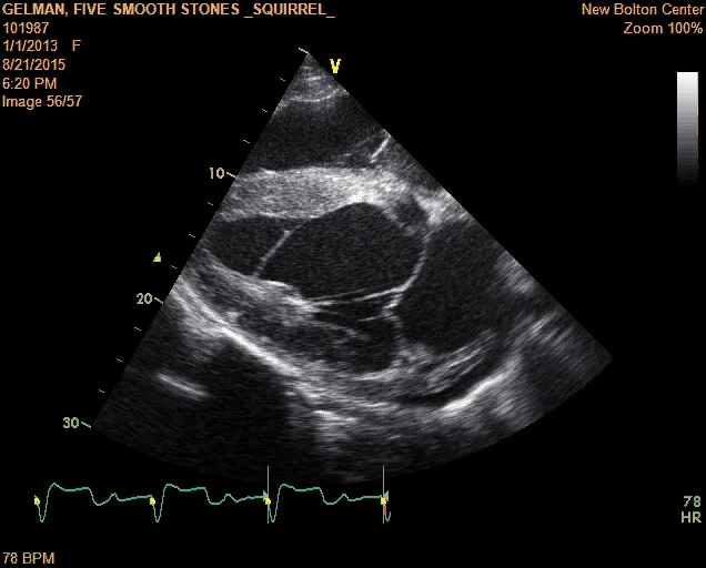 Piedmont Healthcare LV Myocardial Strain Workflow on Siemens SC200 on Vimeo