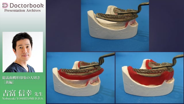 総義歯概形印象の大切さ（後編）