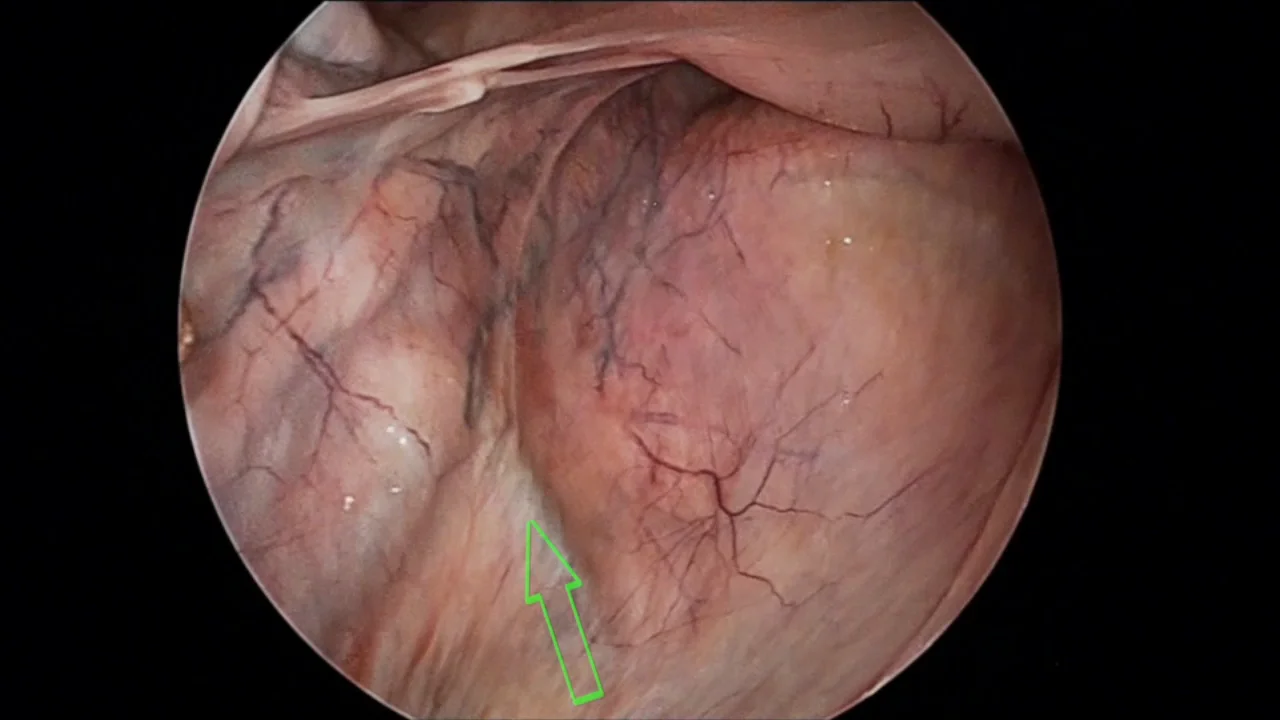 Ooforectomia por video / Video Oophorectomy 