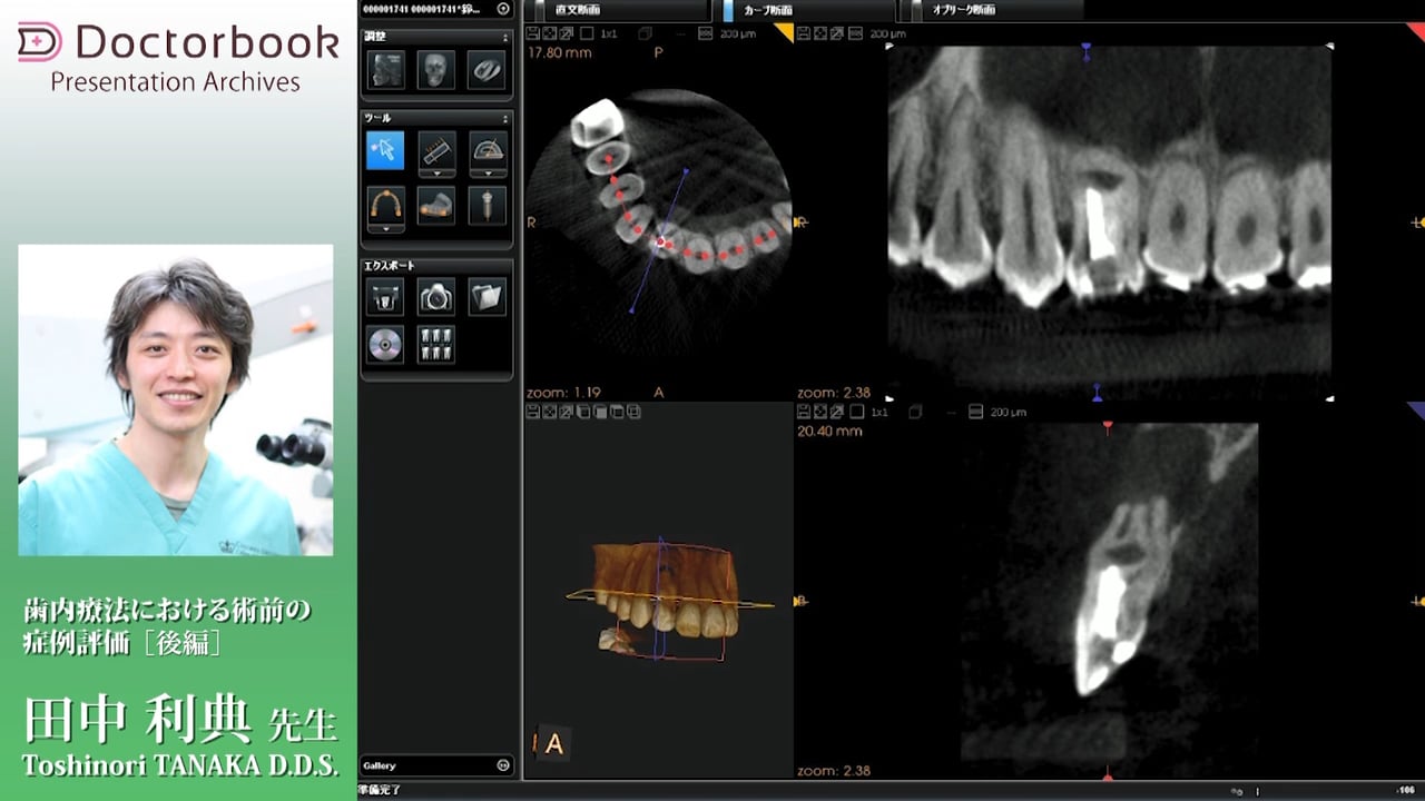 歯内療法における術前の症例評価（後編）