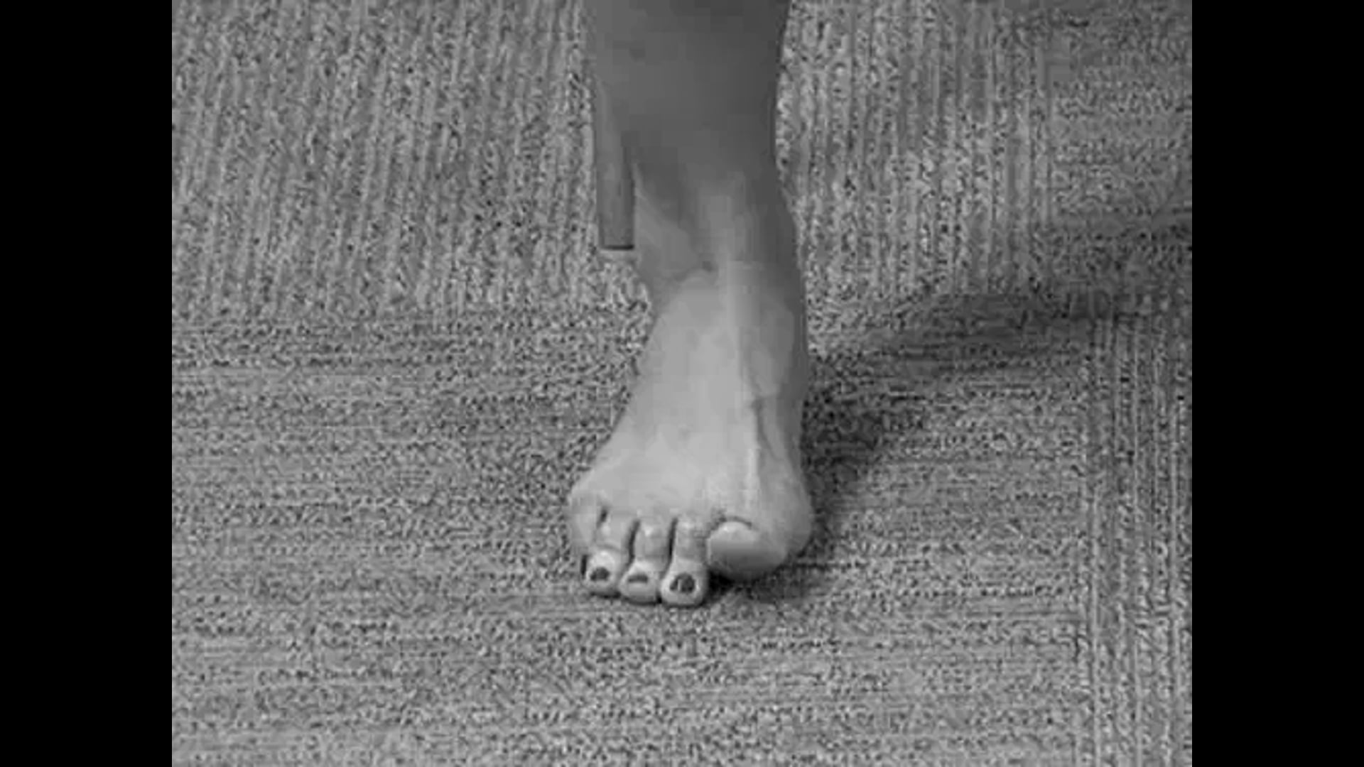 S/P Hammer Toe Correction