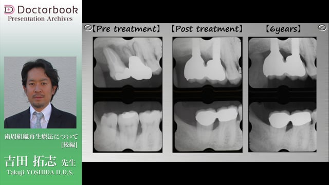 歯周組織再生療法について（後編）