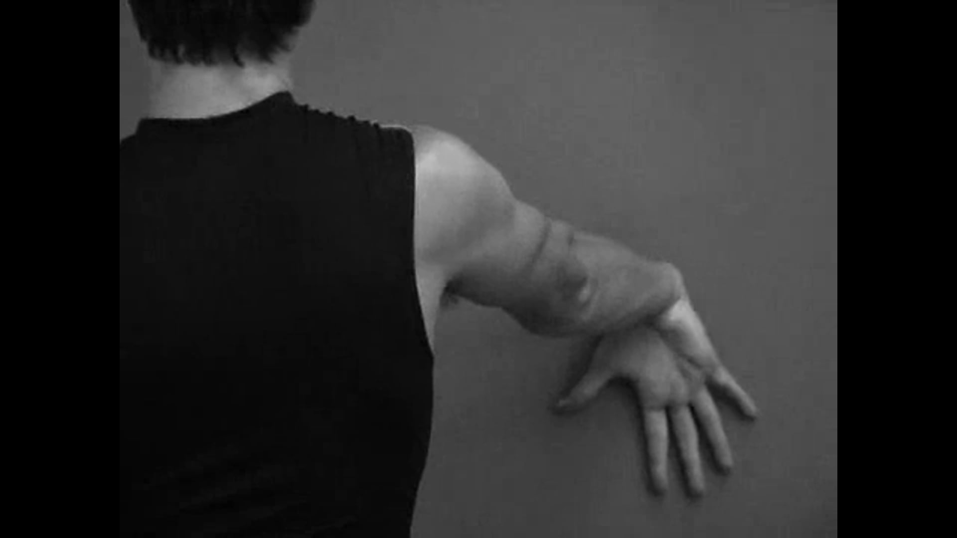 S/P Arthroscopic ECRB Release