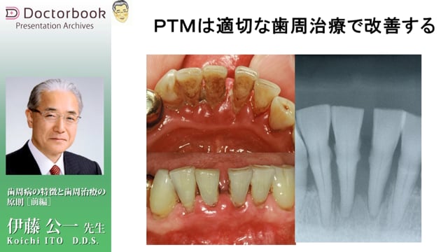 歯周病の特徴と歯周治療の原則