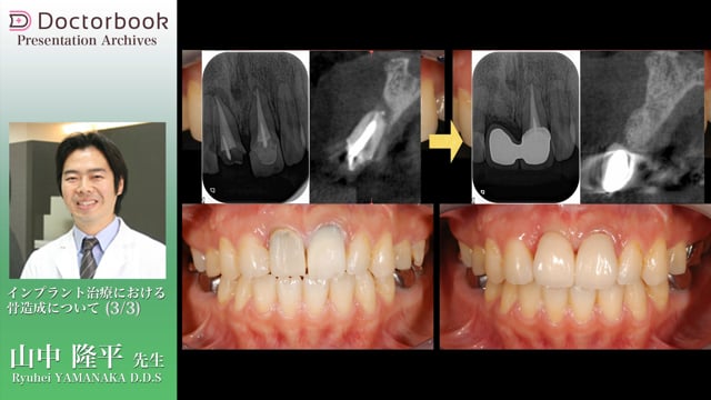 インプラント治療における骨造成について | Doctorbook academy 