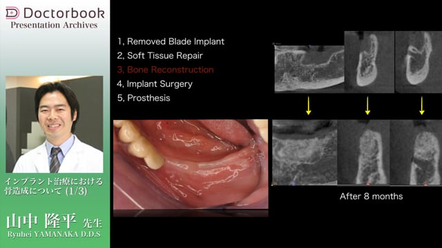 やってみよう！サイナスリフト | Doctorbook academy (ドクターブック 