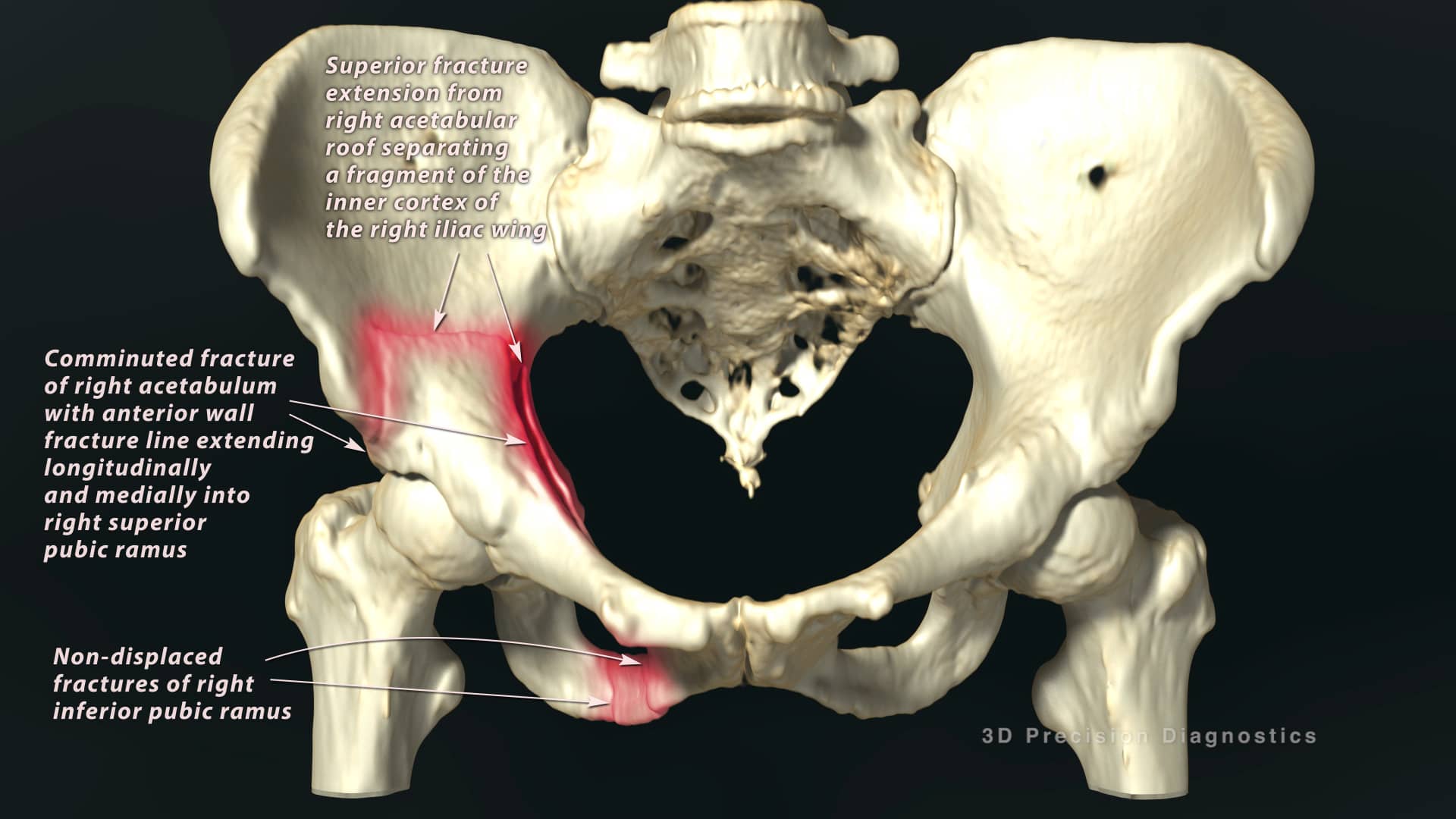 CT Findings: Right Hemipelvis & Acetabular Fractures (R27625-02X) | 3D ...