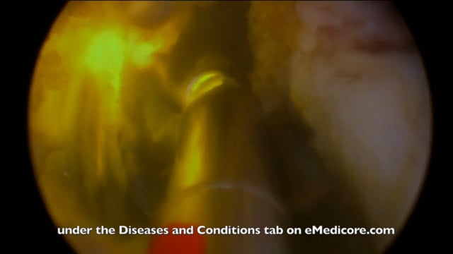 Green Light Laser Vaporization of the Prostate (Photoselective Vaporization of the Prostate)