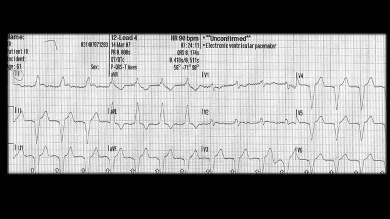 ST Elevation MI in the Setting of a Paced Rhythm on Vimeo