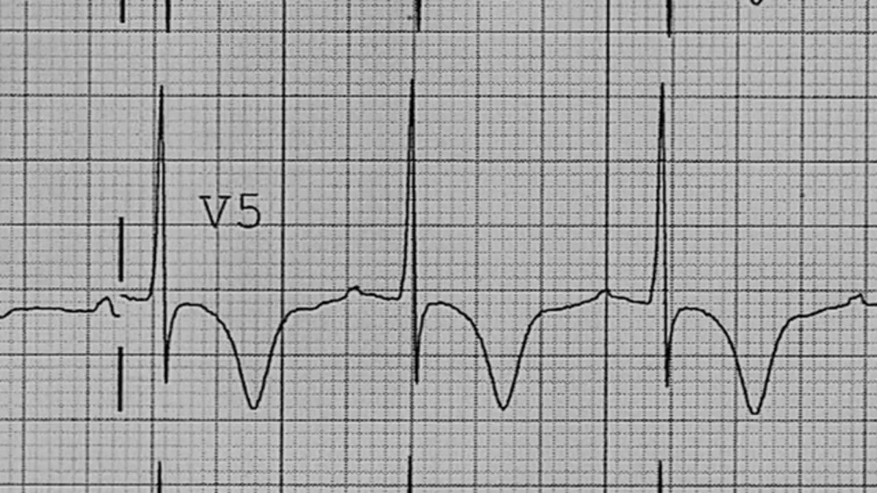 T Wave Inversion Now Evident In Anterolateral Leads