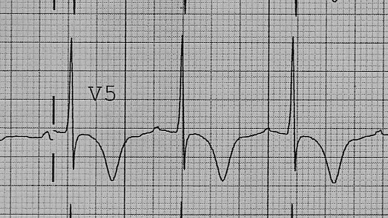 t-wave-inversion-on-vimeo