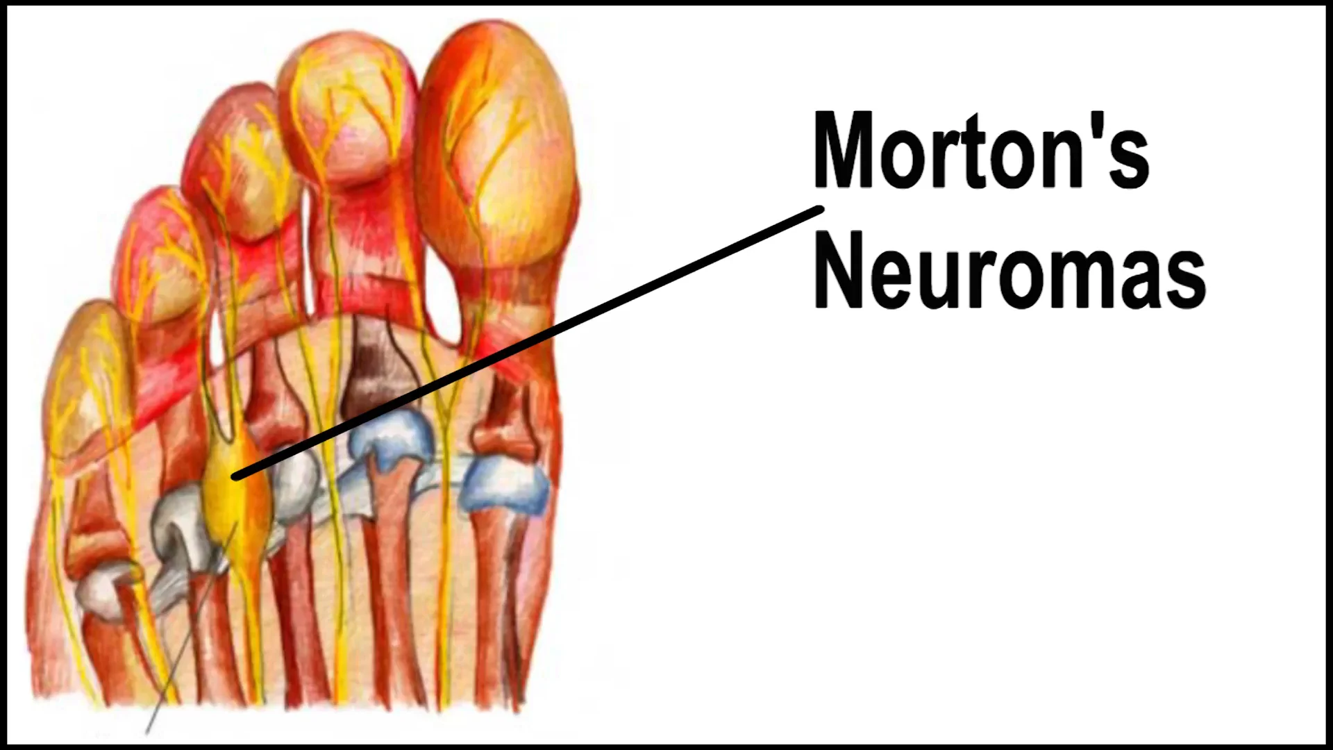 Neuroma латынь. Неврома мортона операция. Неврома мортона гистология. Болезнь неврома мортона. Метатарзалгия неврома мортона.
