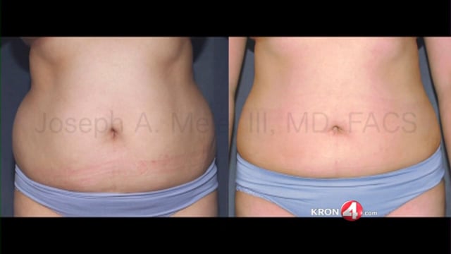 Liposuction Case 4048 < Bay Area Plastic Surgery