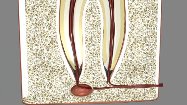 Laser Assisted Root Canal Therapy