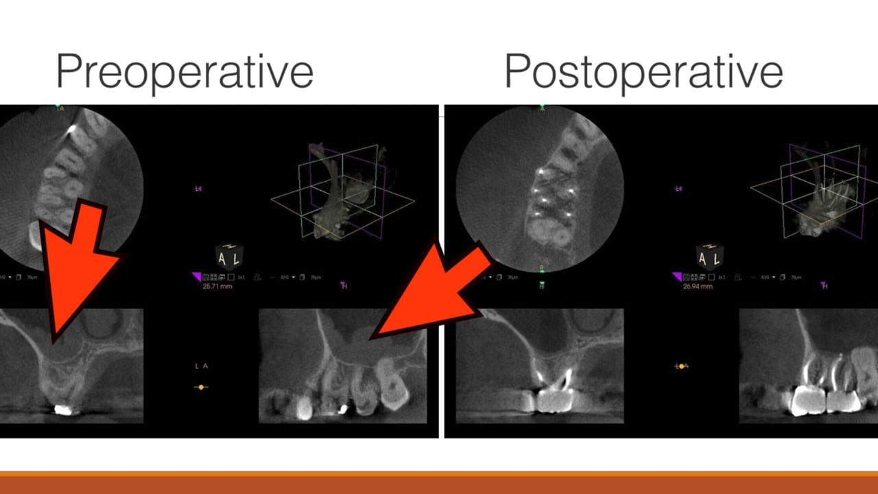 Maxillary Sinusitis of Endodontic Origin A Call To Action! (Part 2) Real World Endo