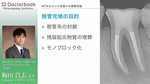 MTAセメントを用いた根管充填