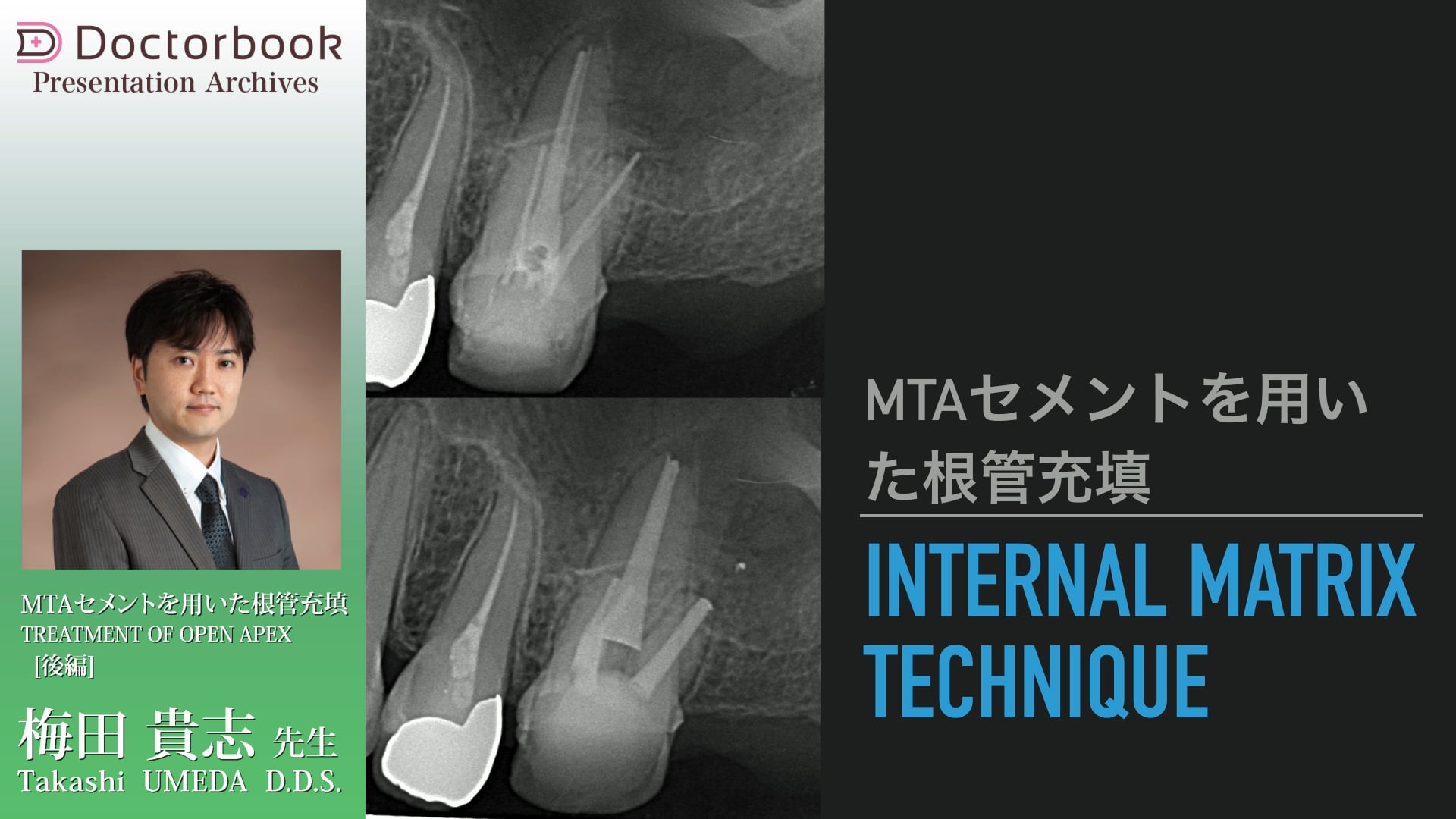 MTAセメントを用いた根管充填（後編）