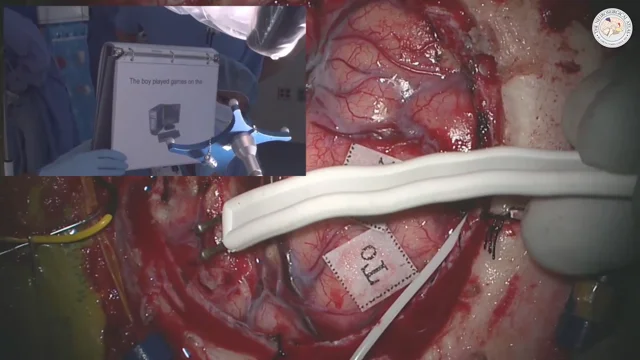 Electrocautery in Brain Surgery - Trial Exhibits Inc.