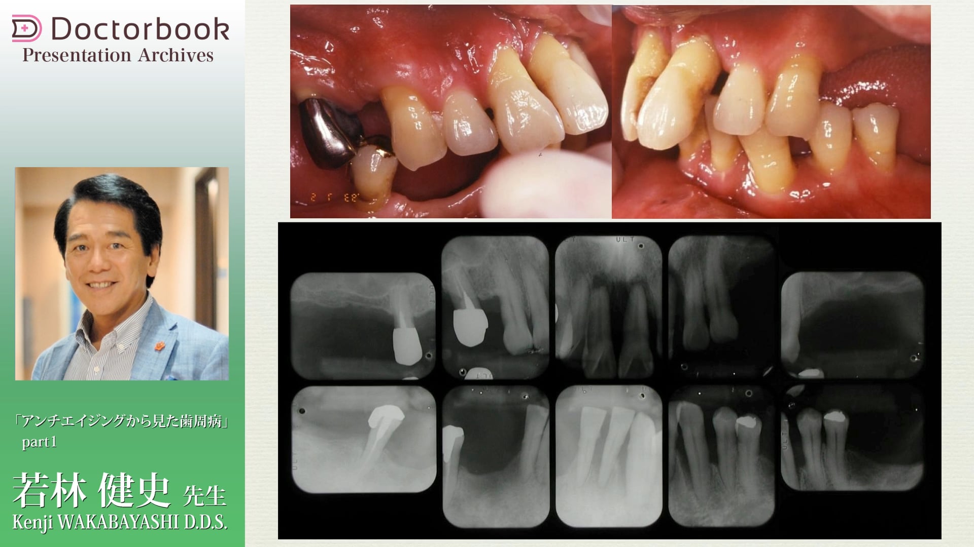 #1 歯周病と全身疾患の関わり