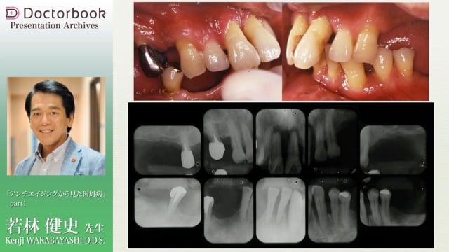 アンチエイジングからみた歯周病 | Doctorbook academy (ドクターブックアカデミー)