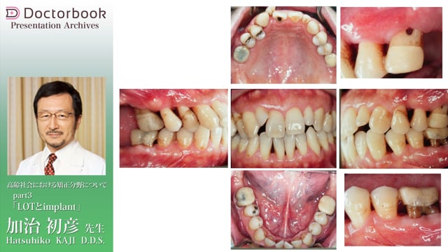 2 LOT（限局矯正）とPTM（病的歯牙移動） | Doctorbook academy 