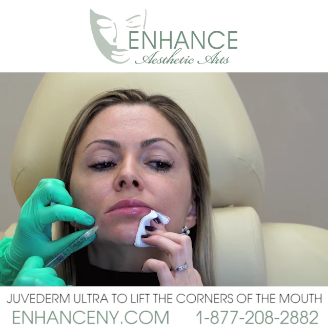 Juvederm Ultra to lift the corners of the mouth Regular on Vimeo