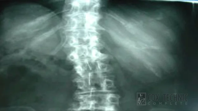 Scoliosis Bracing Burlington Ontario  The Healing Path Chiropractic and  Wellness Centre