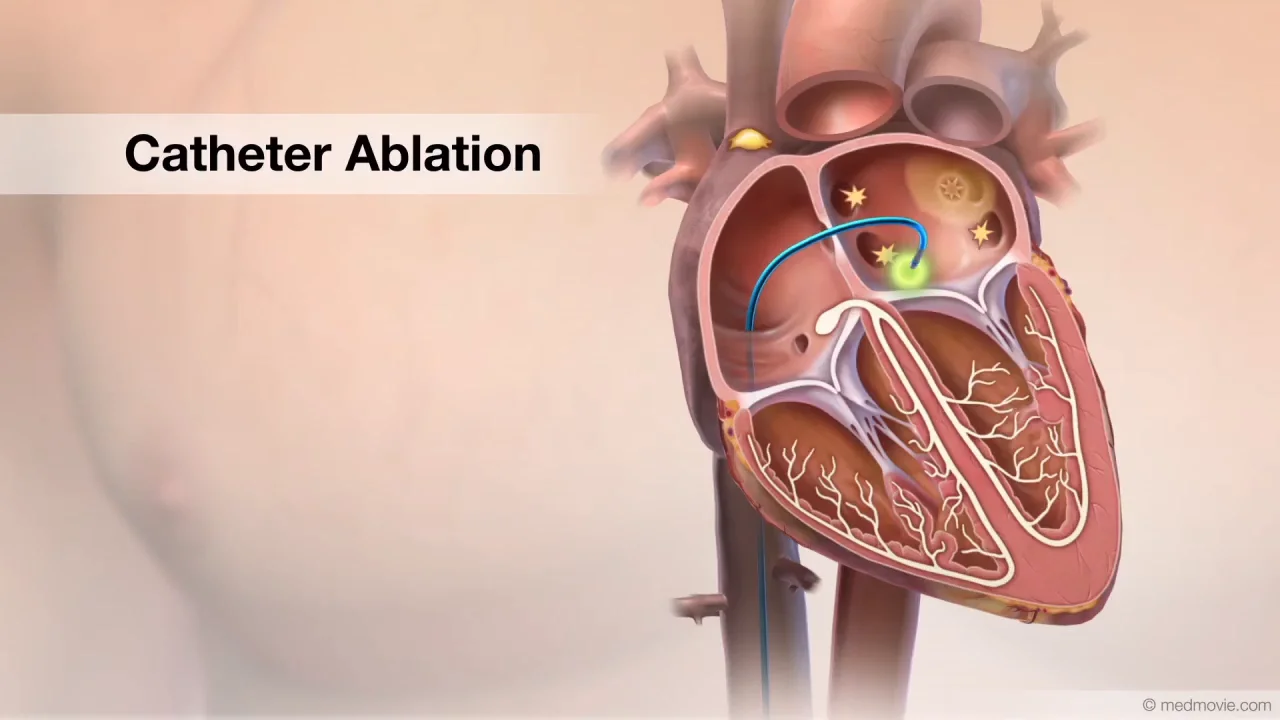 Piedmont Healthcare LV Myocardial Strain Workflow on Siemens SC200 on Vimeo