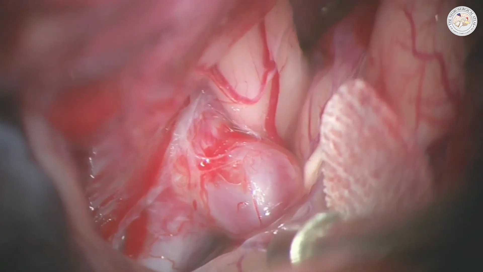 Paraclinoid Aneurysm | Cohen Collection | Volumes | The Paraclinoid Aneurysm | Cohen Collection | Volumes | The