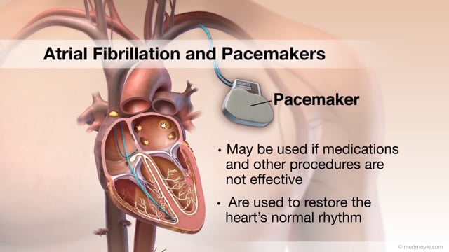 Cardiovascular Videos - Cvml_0413A Atrial Fibrillation Pacemakers 1280X720  On Vimeo