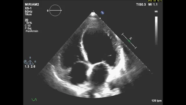 ecocardiograma de insuficiencia cardiaca