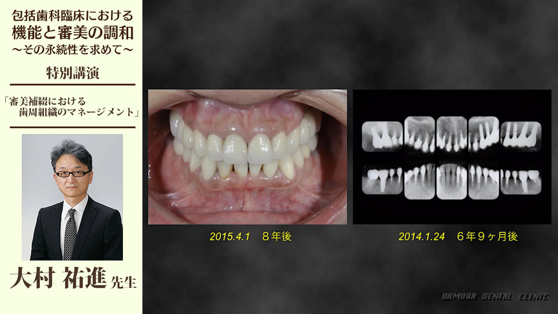 審美補綴における歯周組織のマネージメント #2